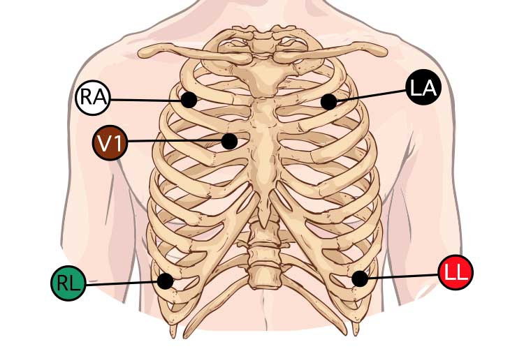 Understanding 5 Lead EKG Placement: A Practical Guide for Biomedical Professionals