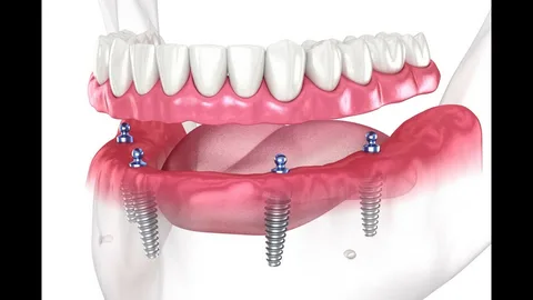 Are You a Candidate for All-on-4 Dental Implants?